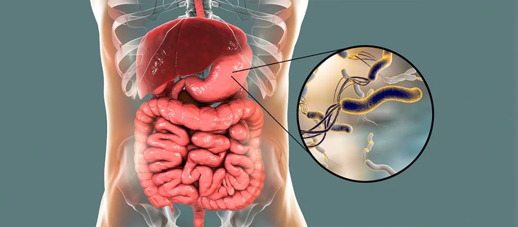 Helicobacter pylori y su relación con el estómago